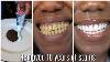 In Two Minutes Remove 10 Years Of Stains From Teeth Results Will Shock You